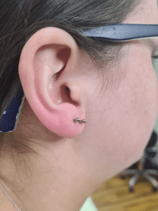 This is a double lobe piercing performed with 2 pieces of implant grade titanium