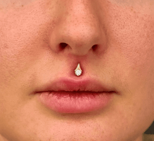 Philtrim piercing performed by Jane at Eternal Gold in Glasgow with a 14kt yellow tulip